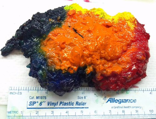Inked Lumpectomy Specimen