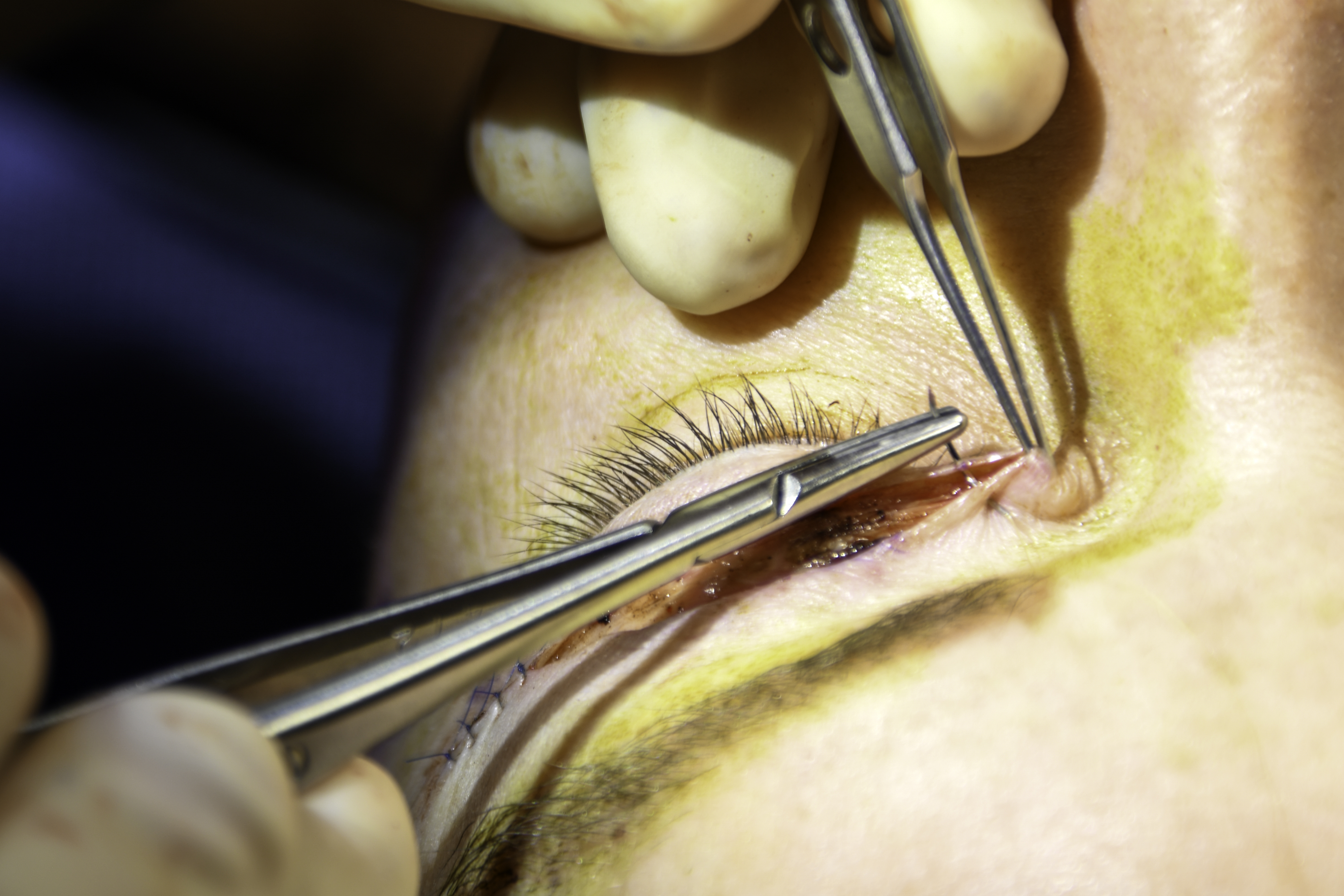 Lateral eyelid suture placement during upper blepharoplasty