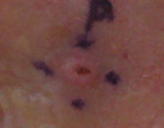 Squamous Cell Carcinoma Left Lateral Canthus