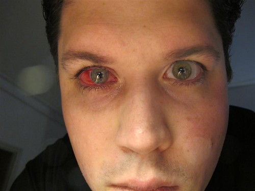 Corneal transplant rejection