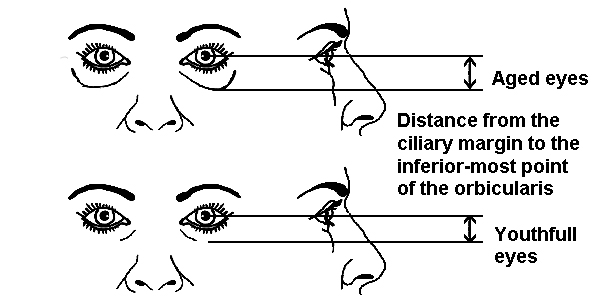 Distance cilliary margin orbicularis oculi