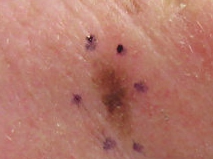 Lentigo Maligna Melanoma Left Central Malar Cheek