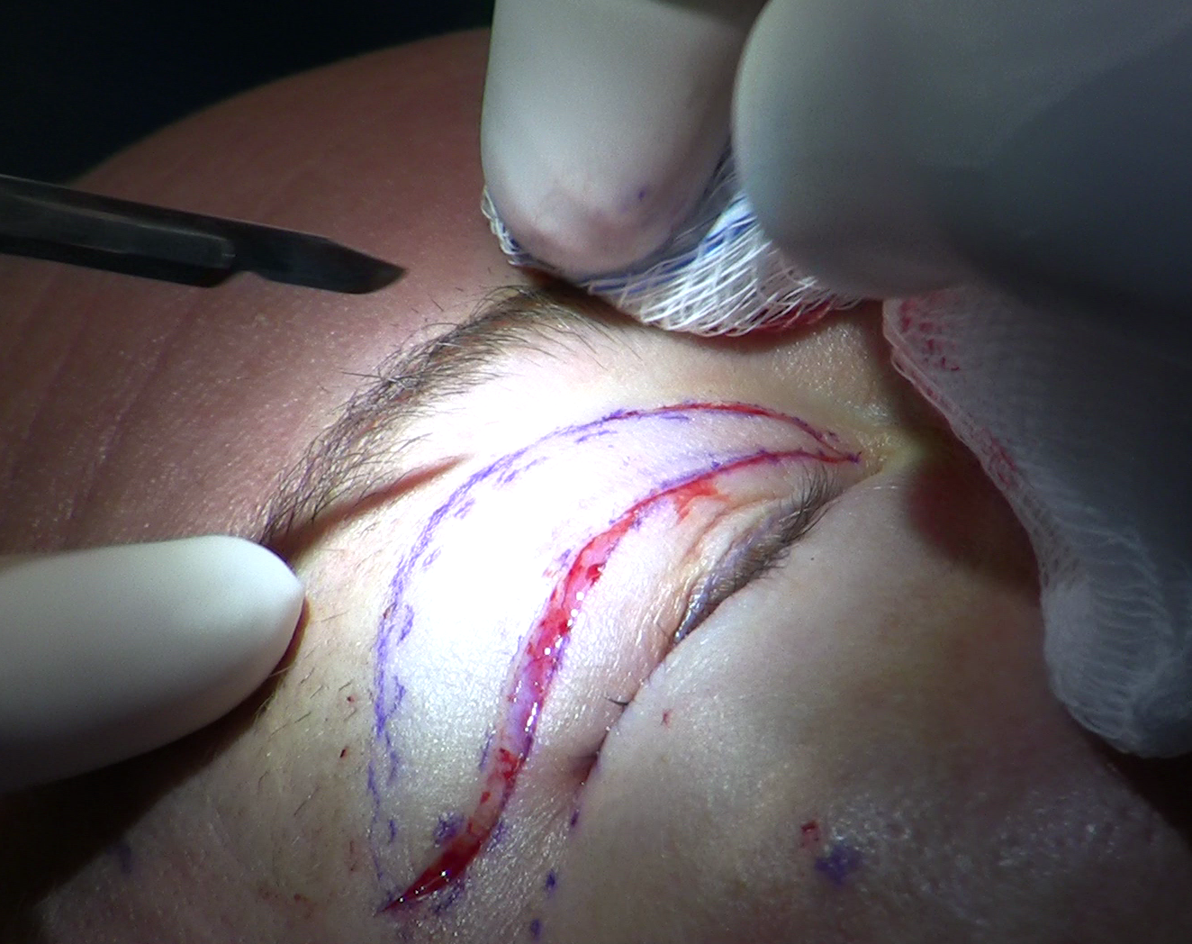 Upper eyelid blepharoplasty incision