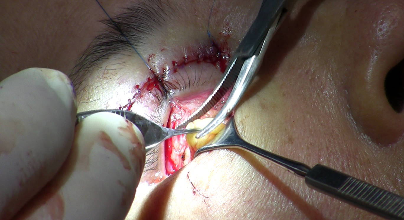 File:Removal of fat from lower eyelid during blepharoplasty 1.jpg