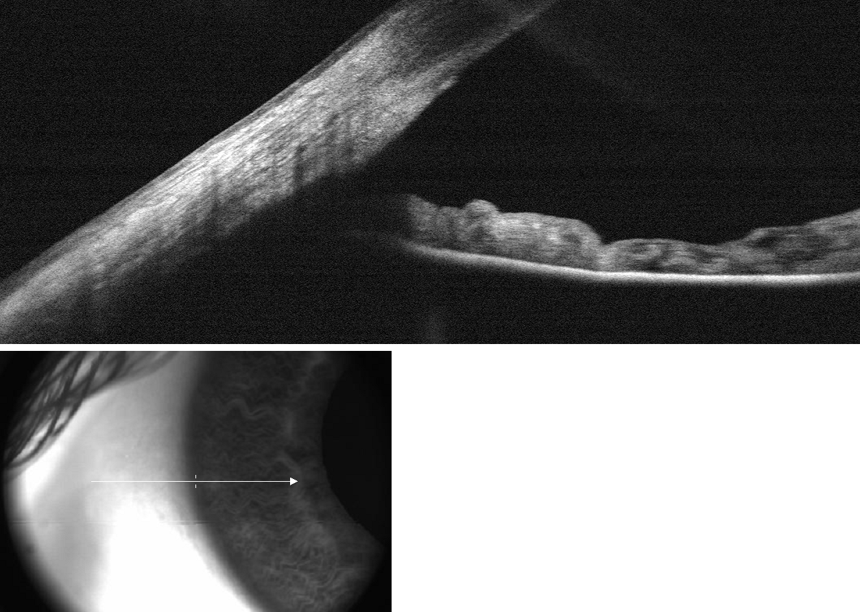 SD OCT - Anterior Chamber Angle Cross-Section (with viewfinder)