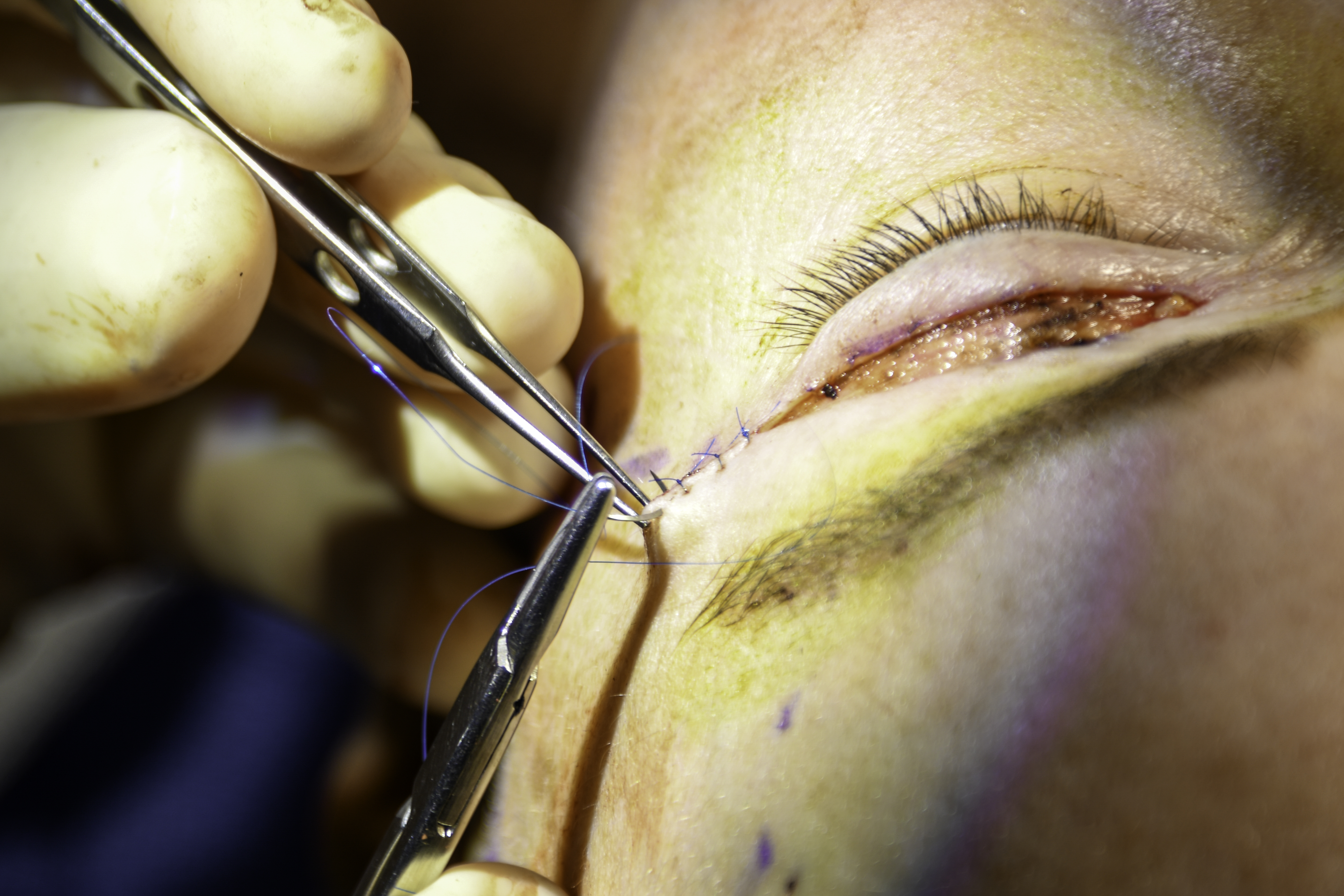 Upper eyelid blepharoplasty incision closure with sutures left eye