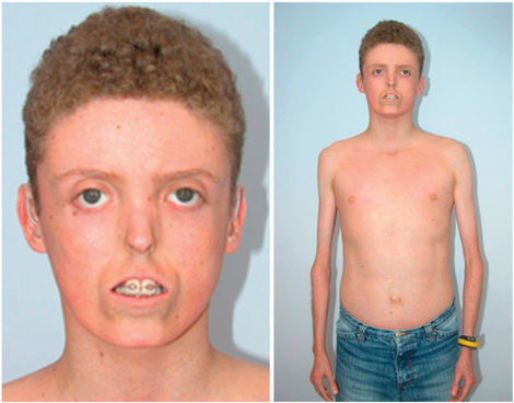 File:Clinical characteristics of individuals with MDP syndrome Figure 1.png