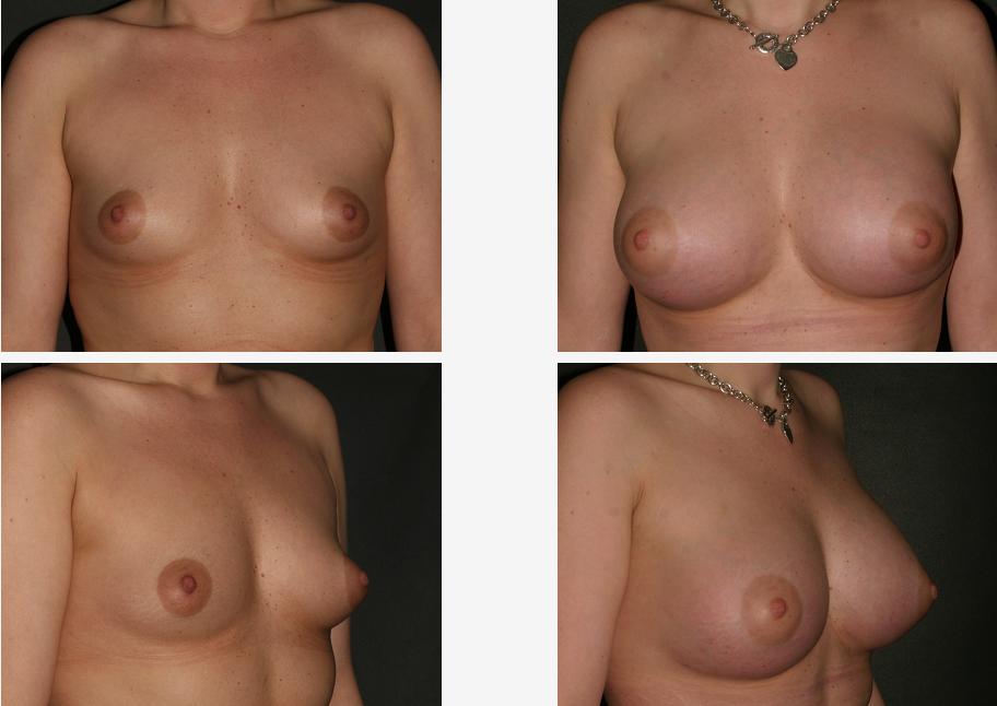 20845 Dr. Placik Chicago Arlington Heights Illinois Fat Grafting Breasts