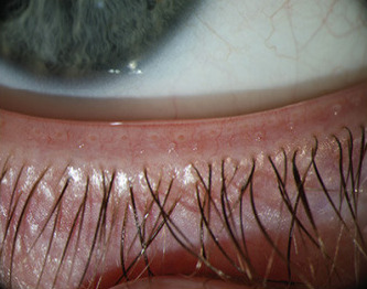 Meibomian Glands (cropped)