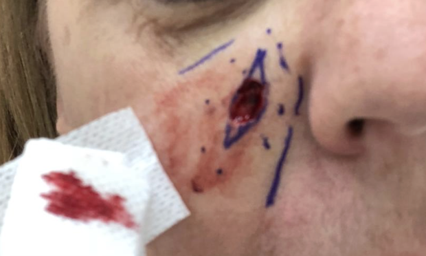 Mohs Surgery Excision Defect Below the Right Eye