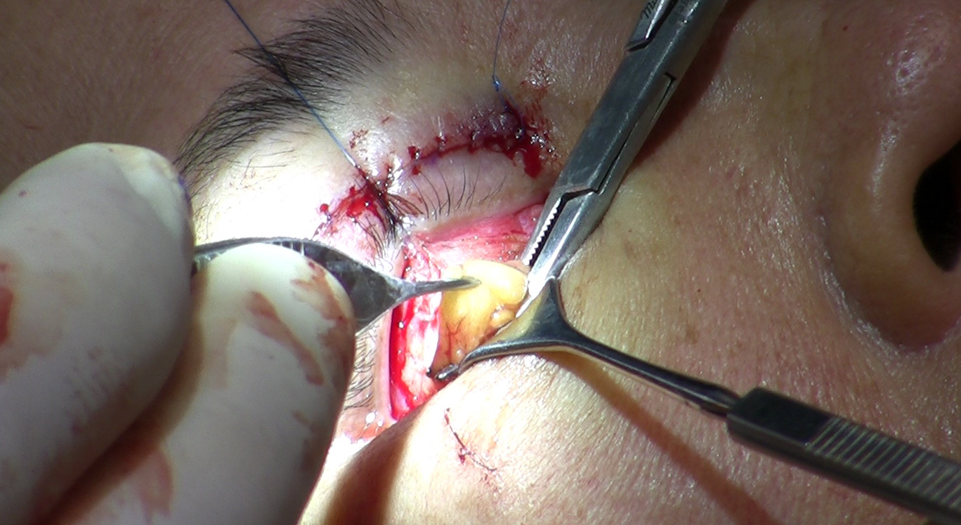 File:Removal of fat from lower eyelid during blepharoplasty 2.jpg