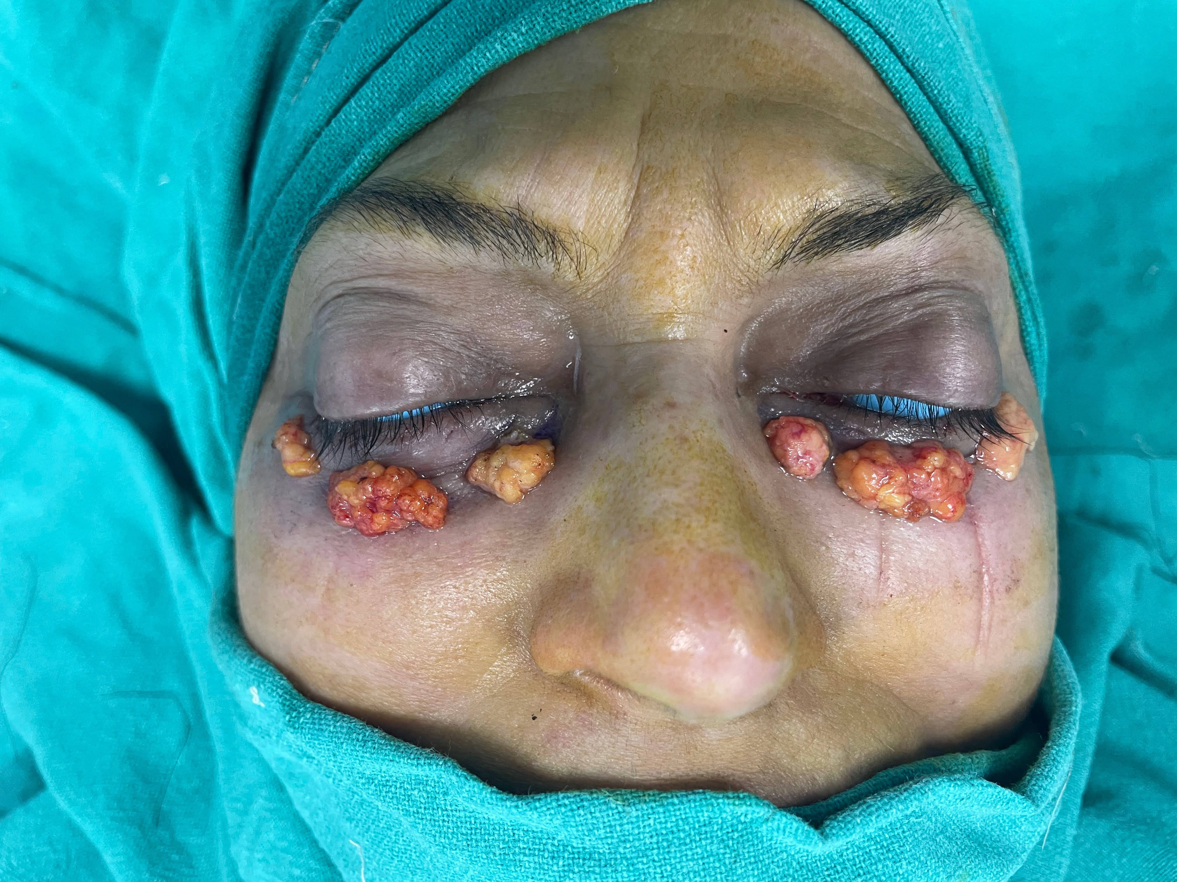Lower Eyelid Blepharoplasty