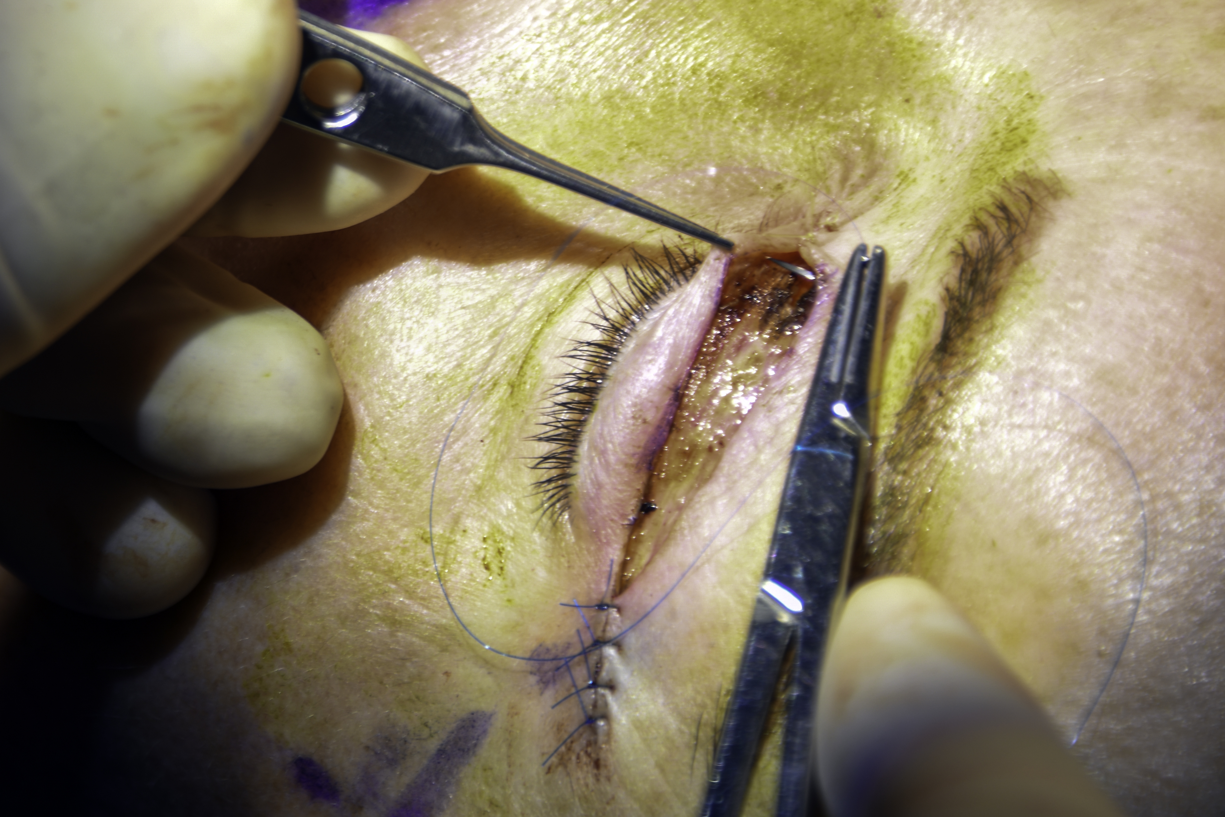 Partial closure of upper eyelid incision during blepharoplasty