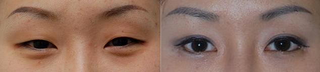 File:East Asian blepharoplasty before after.jpg