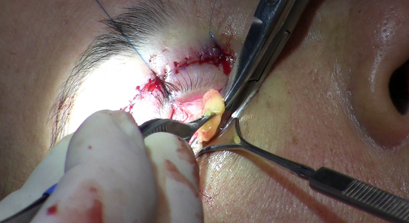 File:Removal of fat from lower eyelid during blepharoplasty 3.jpg