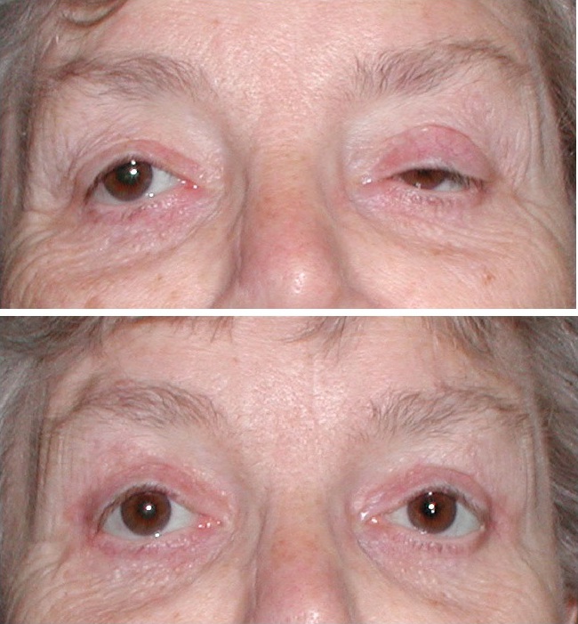 Ptosis Repair Gallery Eyelid And Facial Aesthetics 