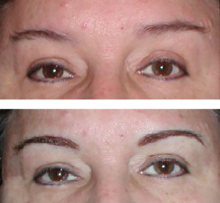 Microblading: Before After - Eyelid Facial Aesthetics