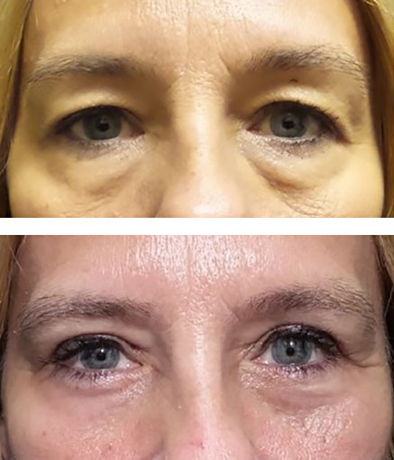 lower eyelid bags removed