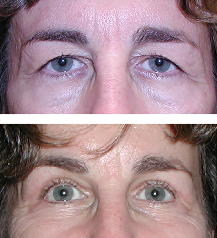 Upper eyelid blepharoplasty relieves heaviness and makes room for makeup