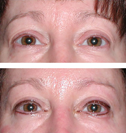 Eyes enhanced immediately with micropigmentation