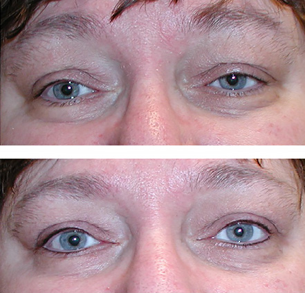 Eyes come alive after micropigmentation