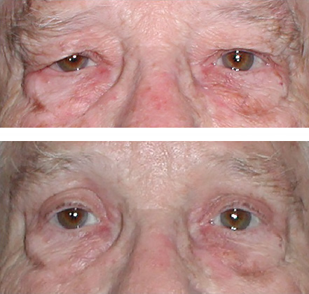 Direct brow lift and blepharoplasty (before and after)