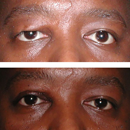Surgical repair of eye trauma