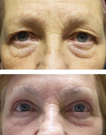 blepharoplasty brow lift (before and after)