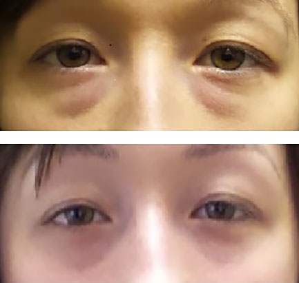 remove lower eyelid bags in a young patient