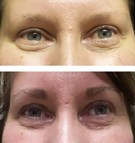 Thicken and frame the eyes with microblading (before/after)