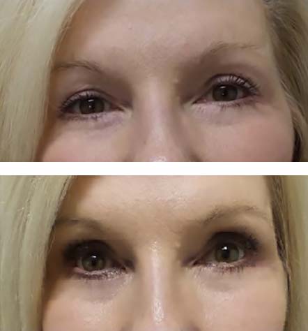 Upper eyelid blepharoplasty relieves heaviness - before and after photos