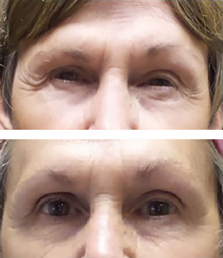 brow lift blepharoplasty - before/after