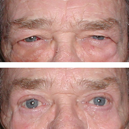 blepharoplasties dramatically restore vision for this patient - compare the before and after image
