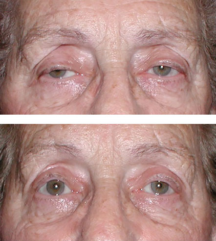 Bilateral ptosis repair of drooping eyelids restores vision