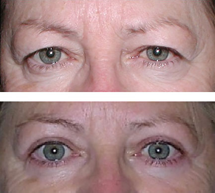 Upper eyelid blepharoplasty makes it easy to open eyes