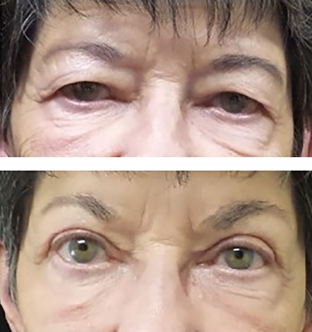blepharoplasty improved vision with brow lift