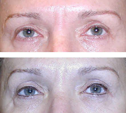 micropigmentation before and after - Charlottesville, Virginia