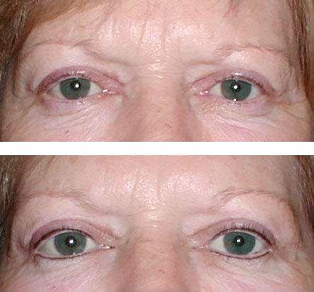 permanent eyeliner with micropigmentation