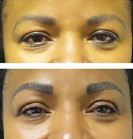 Microblading to thicken and reshape the eyebrows