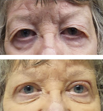 Asian blepharoplasty of the upper lids. Symmetry and vision improved