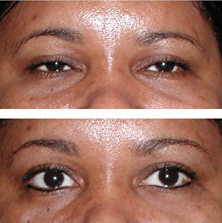 permanent eyeliner - before and after