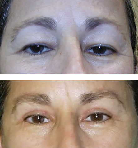 lateral direct brow lift reduced hooding - before after