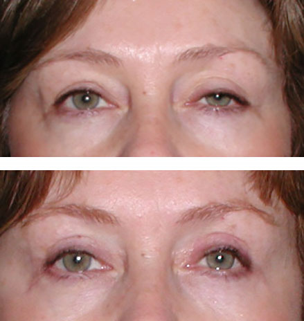 Left drooping eyelid repair improves vision and symmetry