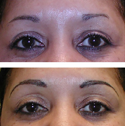 restore eyebrows with micropigmentation (before and after)