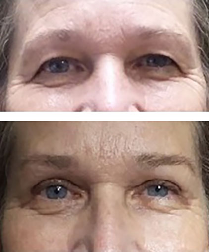 blepharoplasty before after surgery