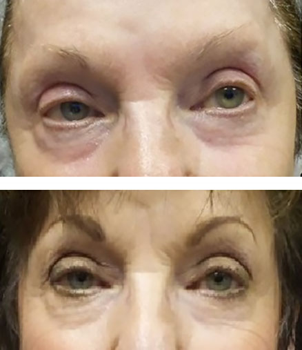 Micropigmented permanent eyebrows create a dramatic look