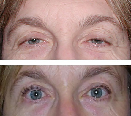 Bilateral repair of droopy eyelids (ptosis surgery)