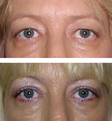 Removal of the eyelid fold makes room for makeup and reduces heaviness - before and after blepharoplasty surgery