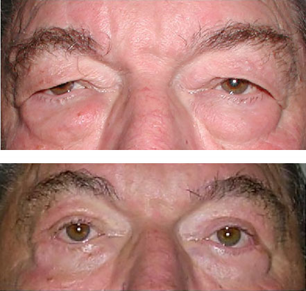 blepharoplasty brow lift before and after surgery
