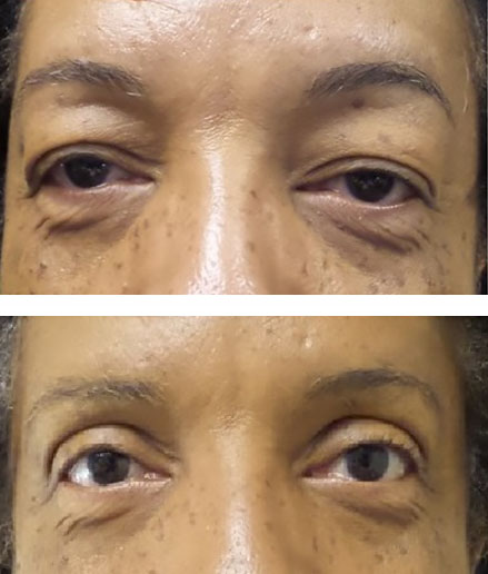 Lid position improves after upper eyelid blepharoplasty - Charlottesville, VA